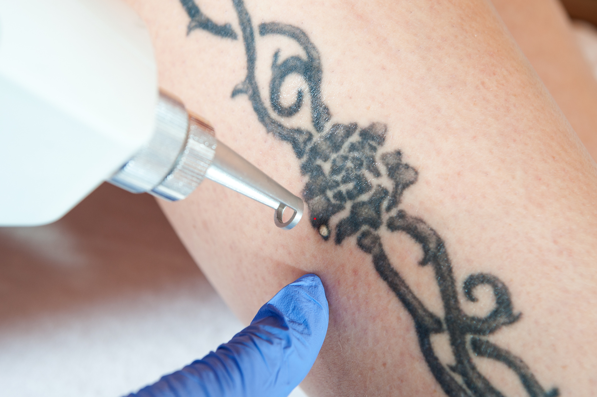 TATTOO REMOVAL, COLCHESTER, ESSEX